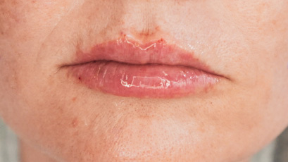 Gouri PCL and Hyafillia Lip Filler - treatment image