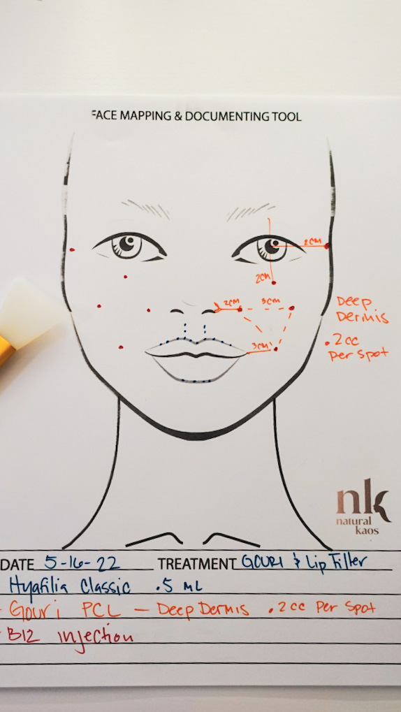 Gouri PCL and Hyafillia Lip Filler - treatment image