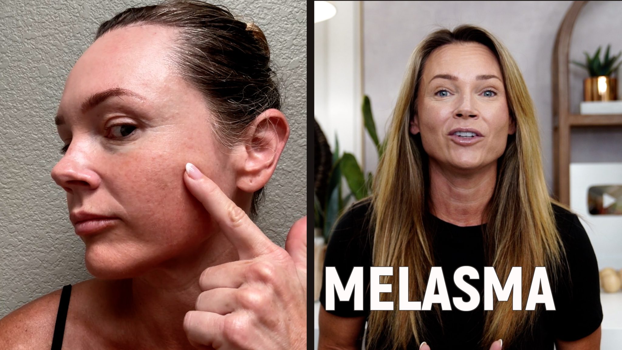 Using Melanotan to Prevent Polymorphous Light Eruption aka SUN POISONING - treatment image