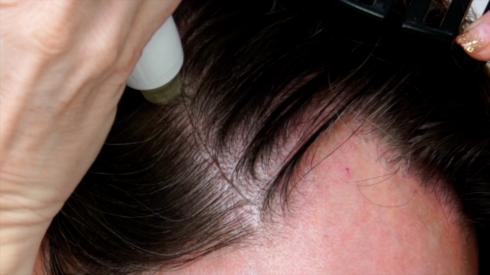 Hair Growth with Microneedling at Home - treatment image