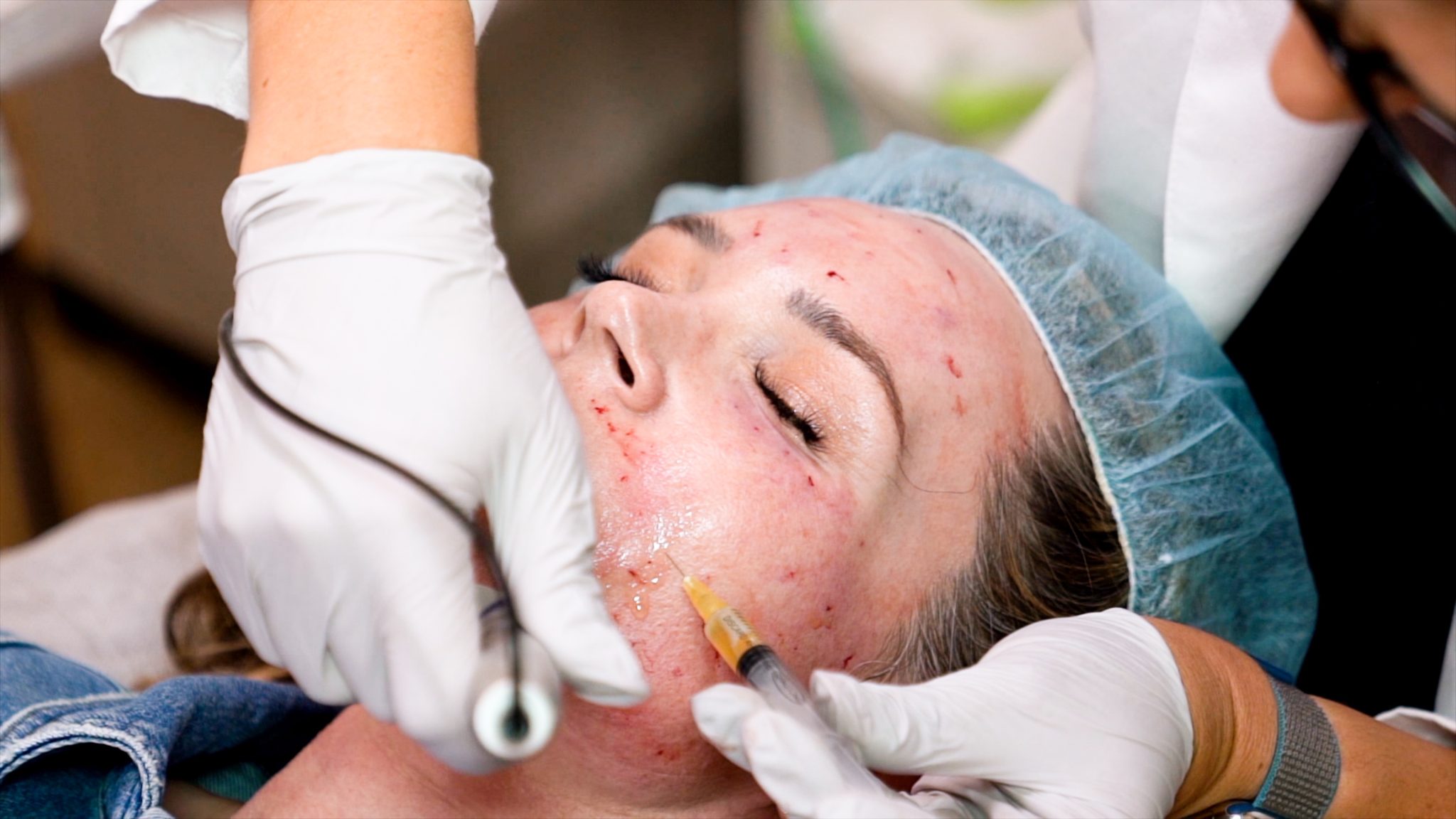 Can you get HIV from a Vampire Facial? Are PRP Injections safe? - treatment image