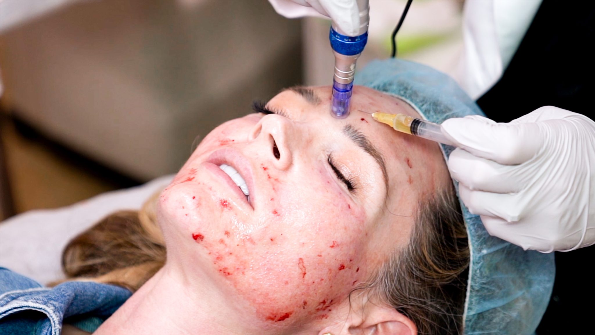 Can you get HIV from a Vampire Facial? Are PRP Injections safe? - treatment image