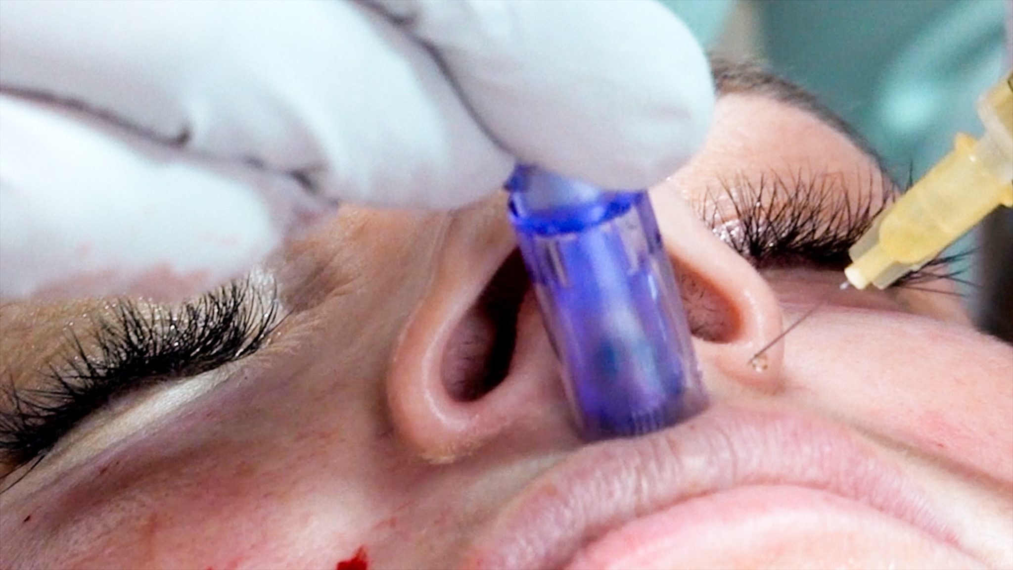 Can you get HIV from a Vampire Facial? Are PRP Injections safe? - treatment image