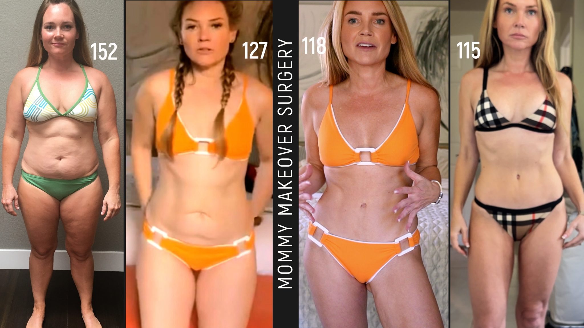 Ozempic weight loss before and after vs Gastric Sleeve: Did Semiglutide Ruin My Hair?
