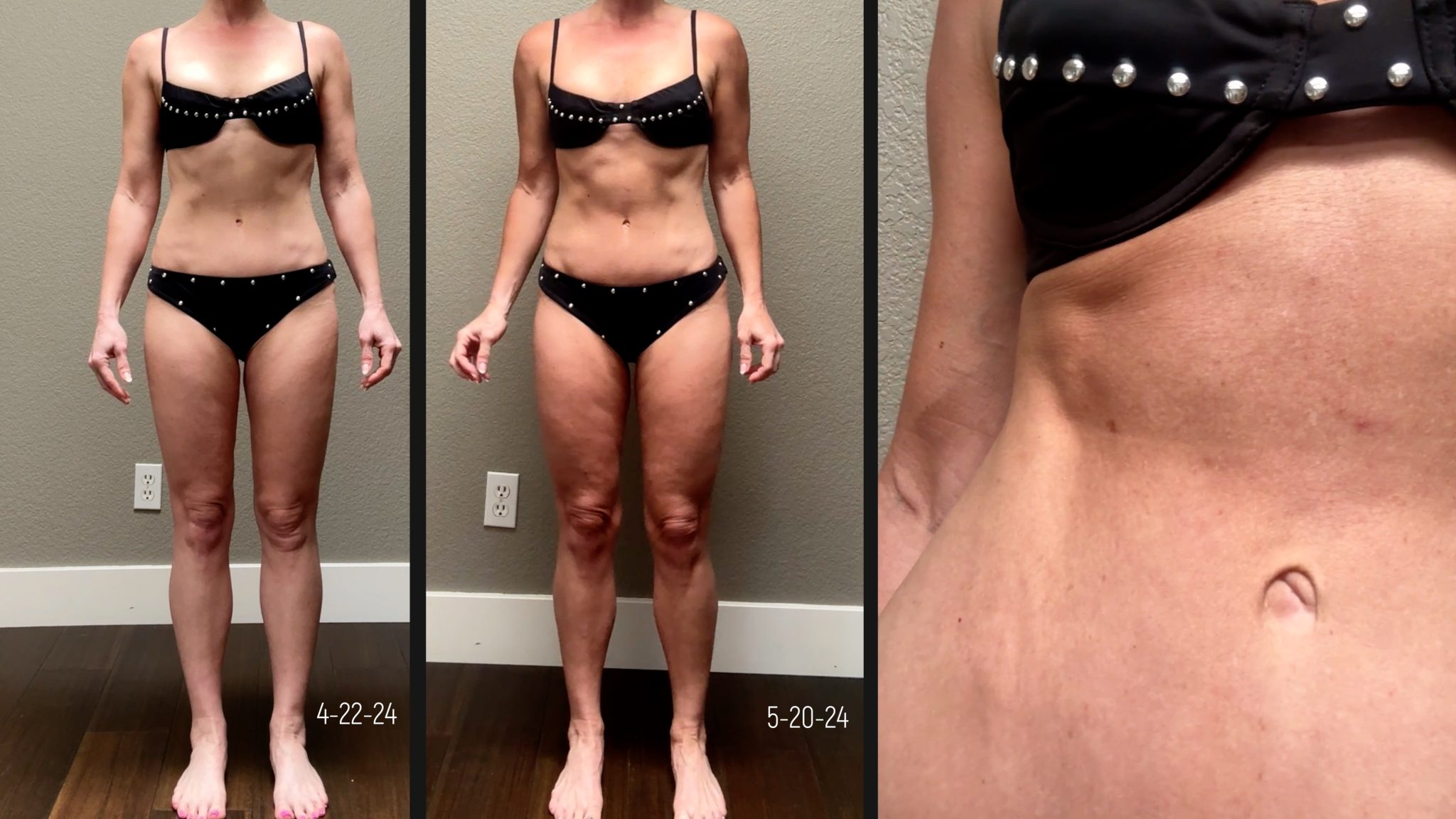 Melanotan 1 vs. 2: My Summer Journey & Real Results - treatment image