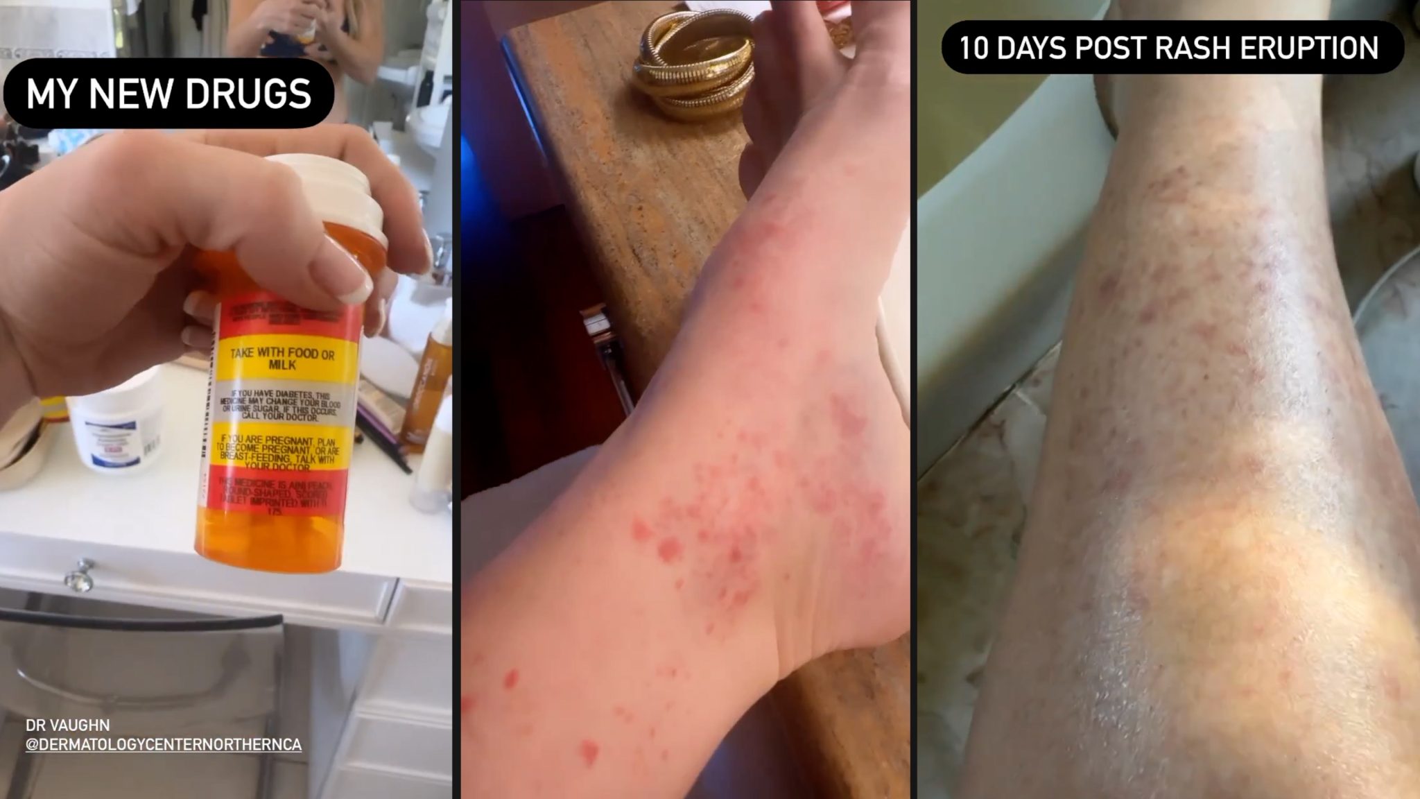 Using Melanotan to Prevent Polymorphous Light Eruption aka SUN POISONING - treatment image