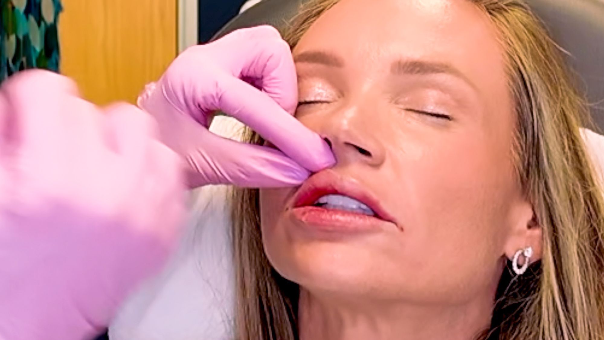 Restylane Kysse Lip Filler: Why the Cannula Method is a Game Changer! - treatment image