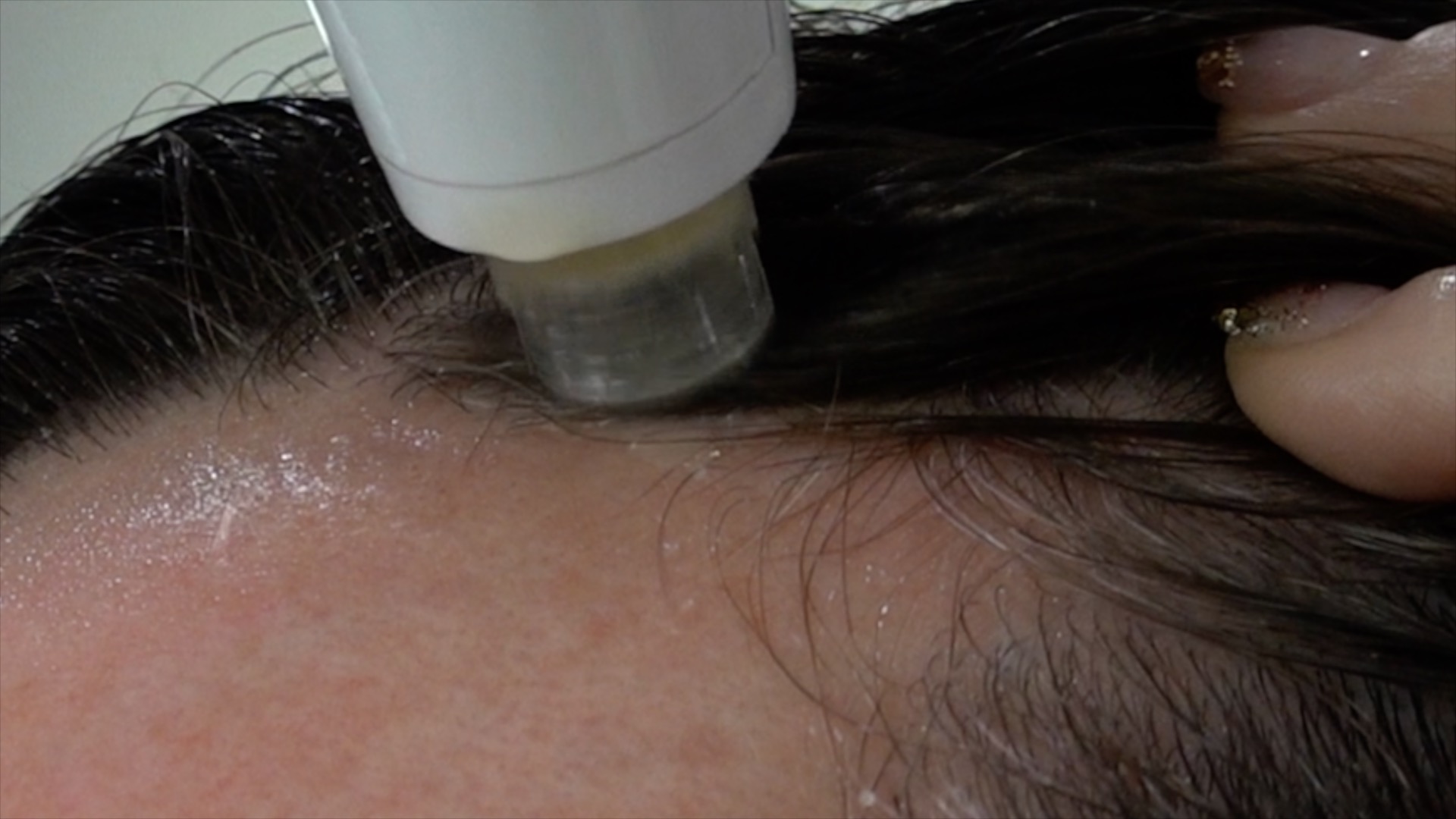 Hair Growth with Microneedling at Home - treatment image