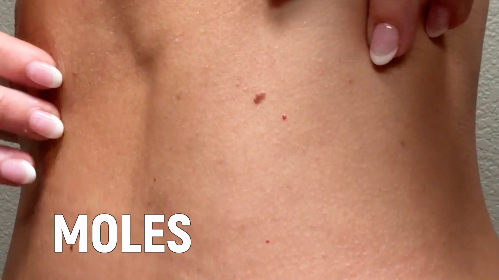 Using Melanotan to Prevent Polymorphous Light Eruption aka SUN POISONING - treatment image
