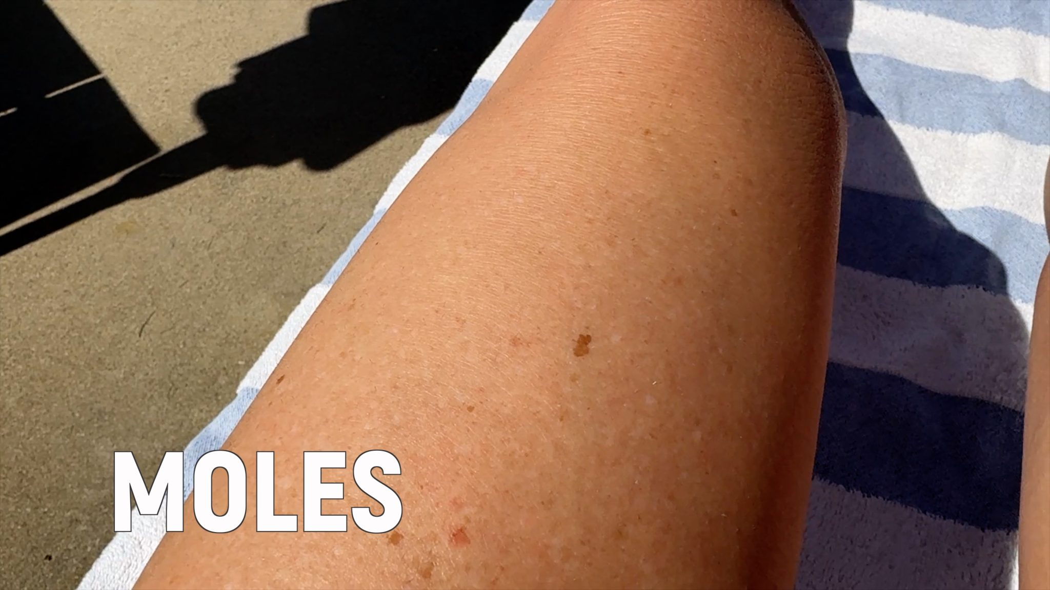 Using Melanotan to Prevent Polymorphous Light Eruption aka SUN POISONING - treatment image