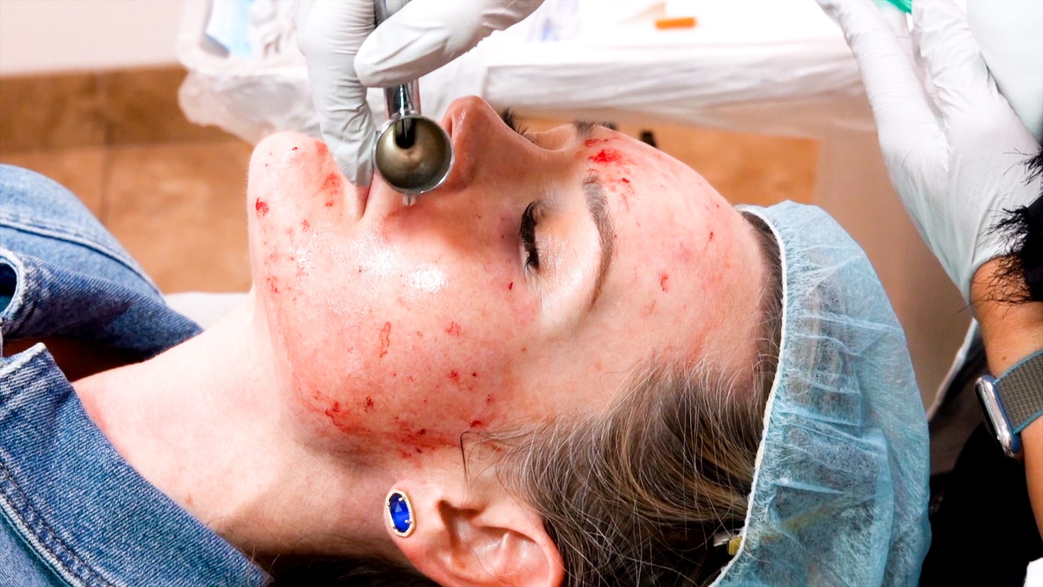 Can you get HIV from a Vampire Facial? Are PRP Injections safe? - treatment image