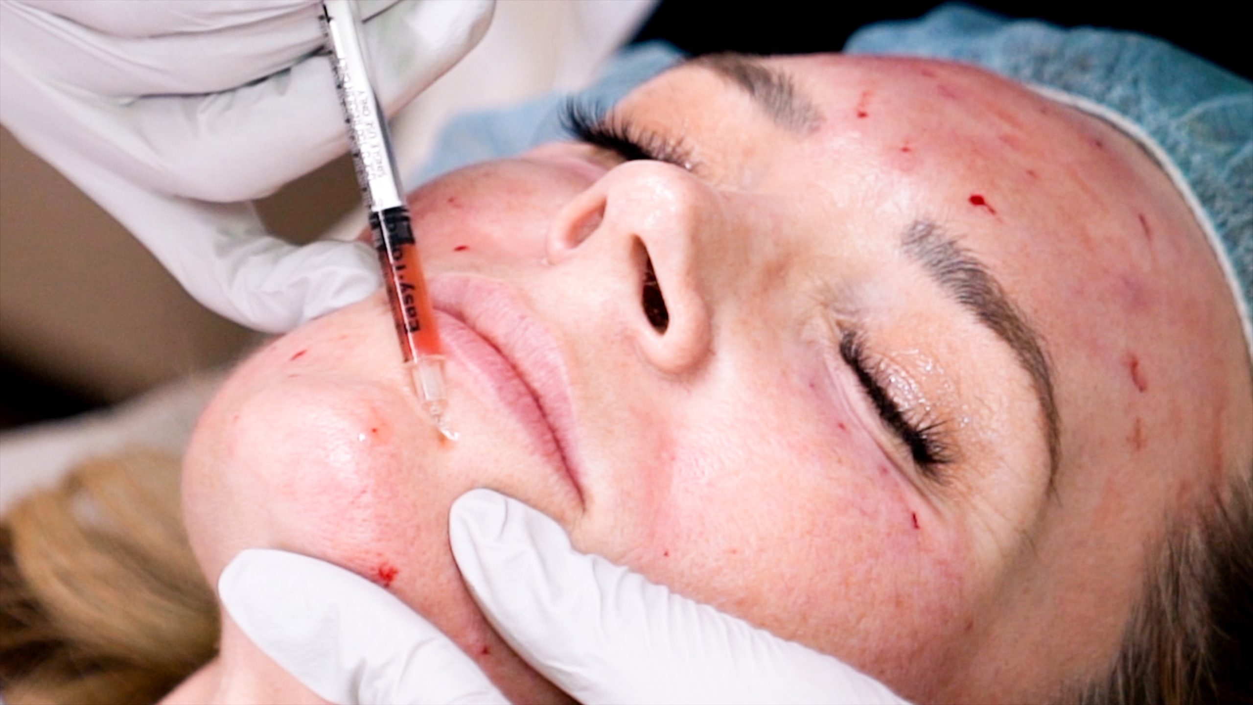 Can you get HIV from a Vampire Facial? Are PRP Injections safe?