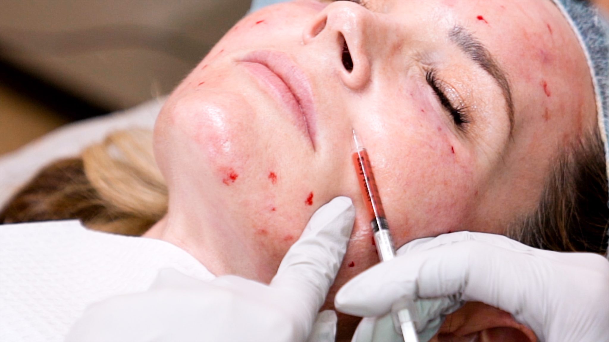Can you get HIV from a Vampire Facial? Are PRP Injections safe? - treatment image