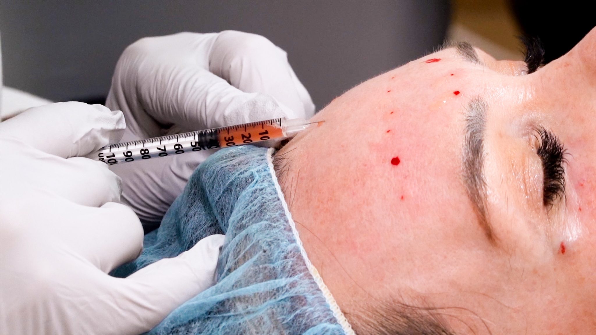 Can you get HIV from a Vampire Facial? Are PRP Injections safe? - treatment image