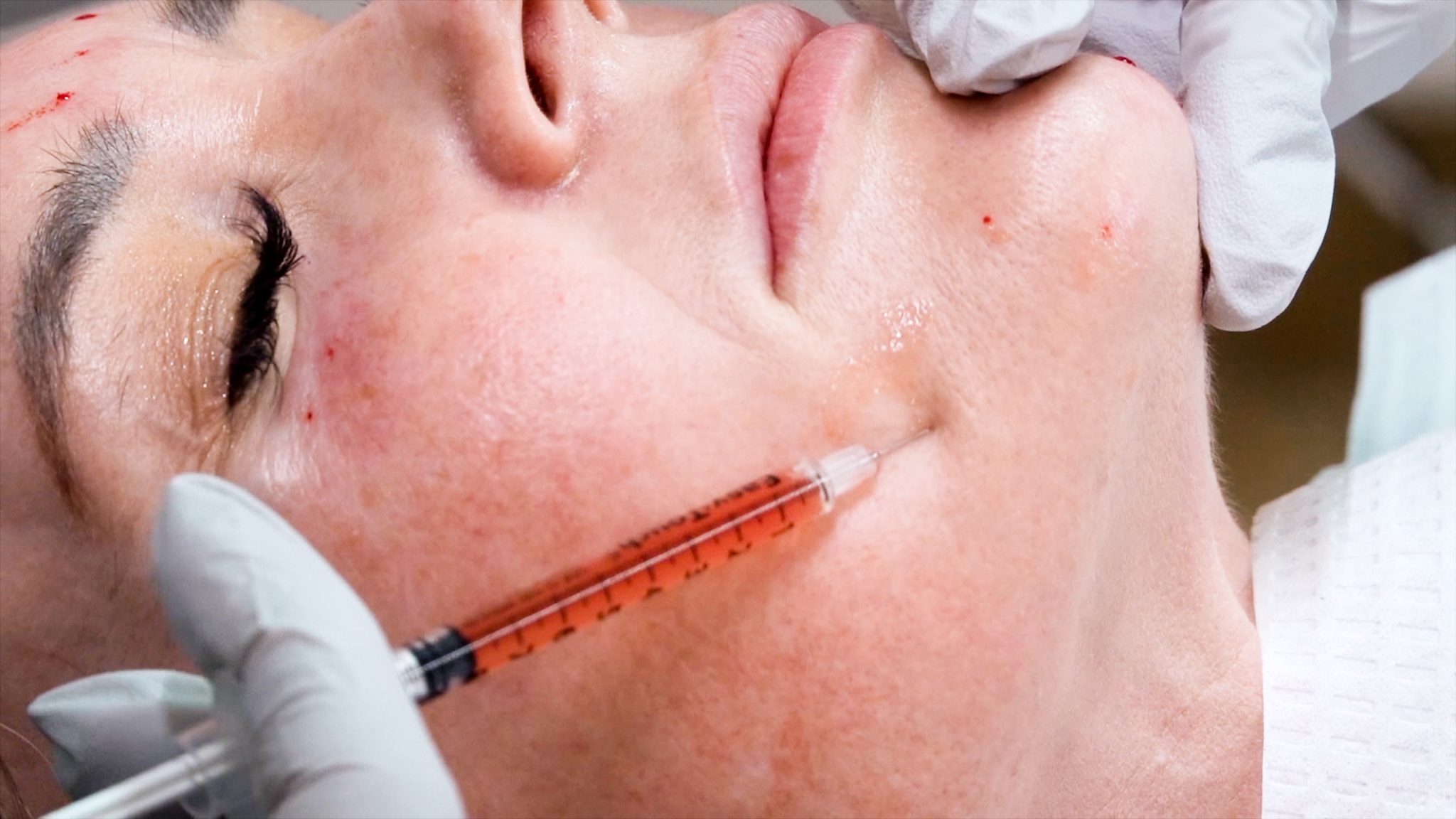 Can you get HIV from a Vampire Facial? Are PRP Injections safe? - treatment image