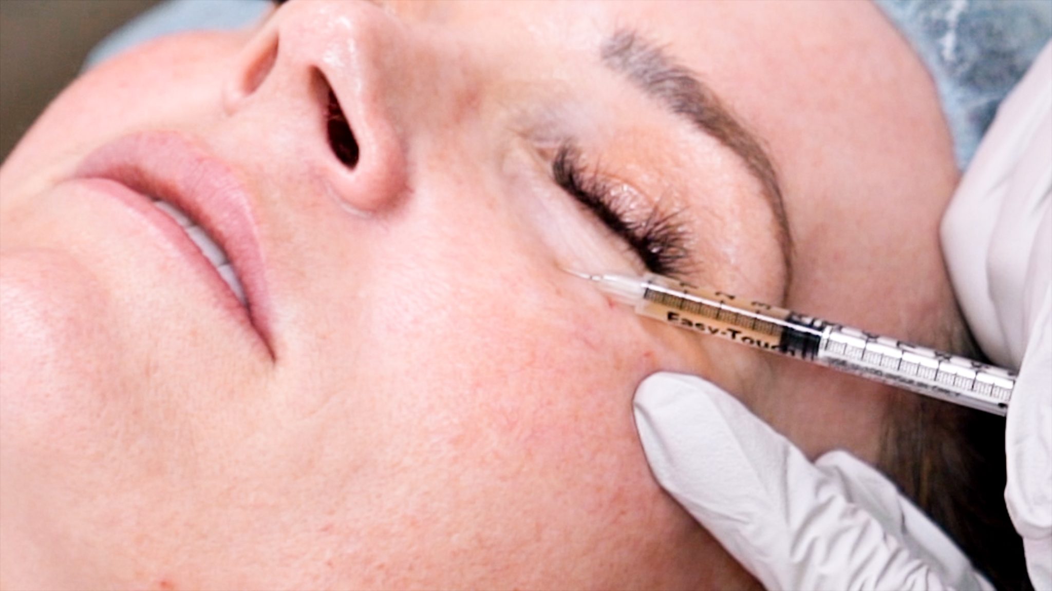 Can you get HIV from a Vampire Facial? Are PRP Injections safe? - treatment image