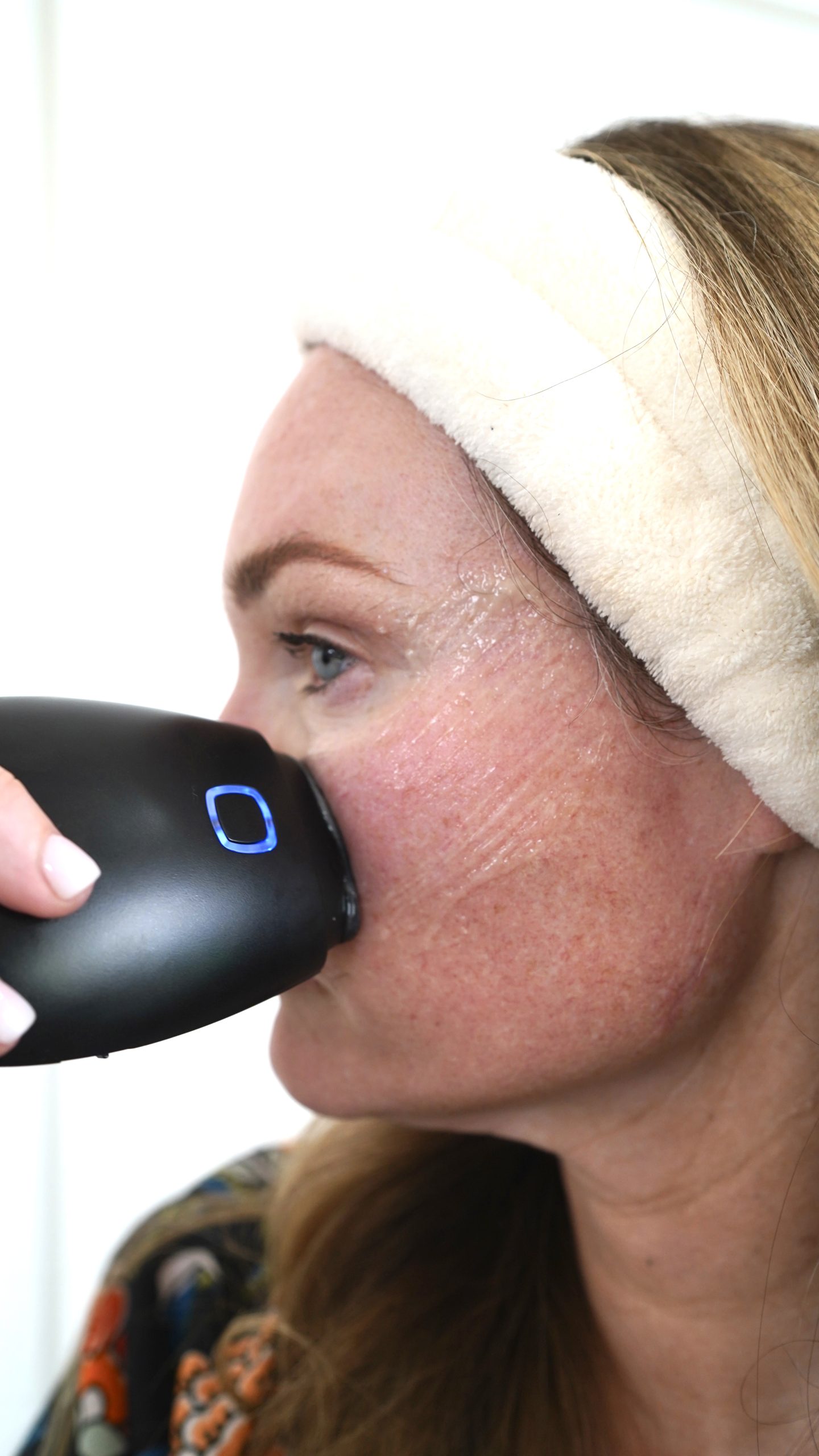 NEWA RADIO FREQUENCY DEVICE - treatment image