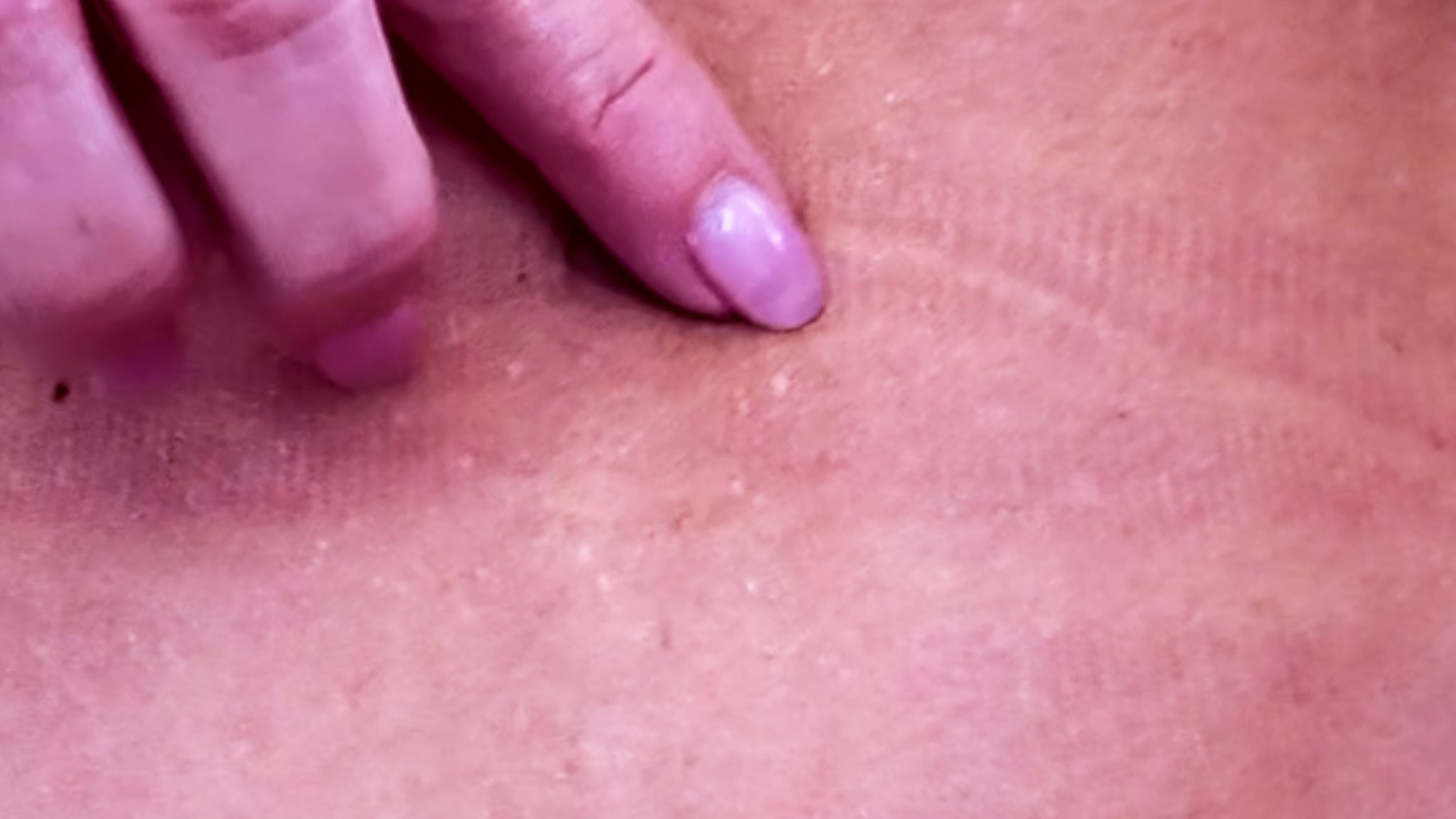 Melanotan 1 vs. 2: My Summer Journey & Real Results - treatment image