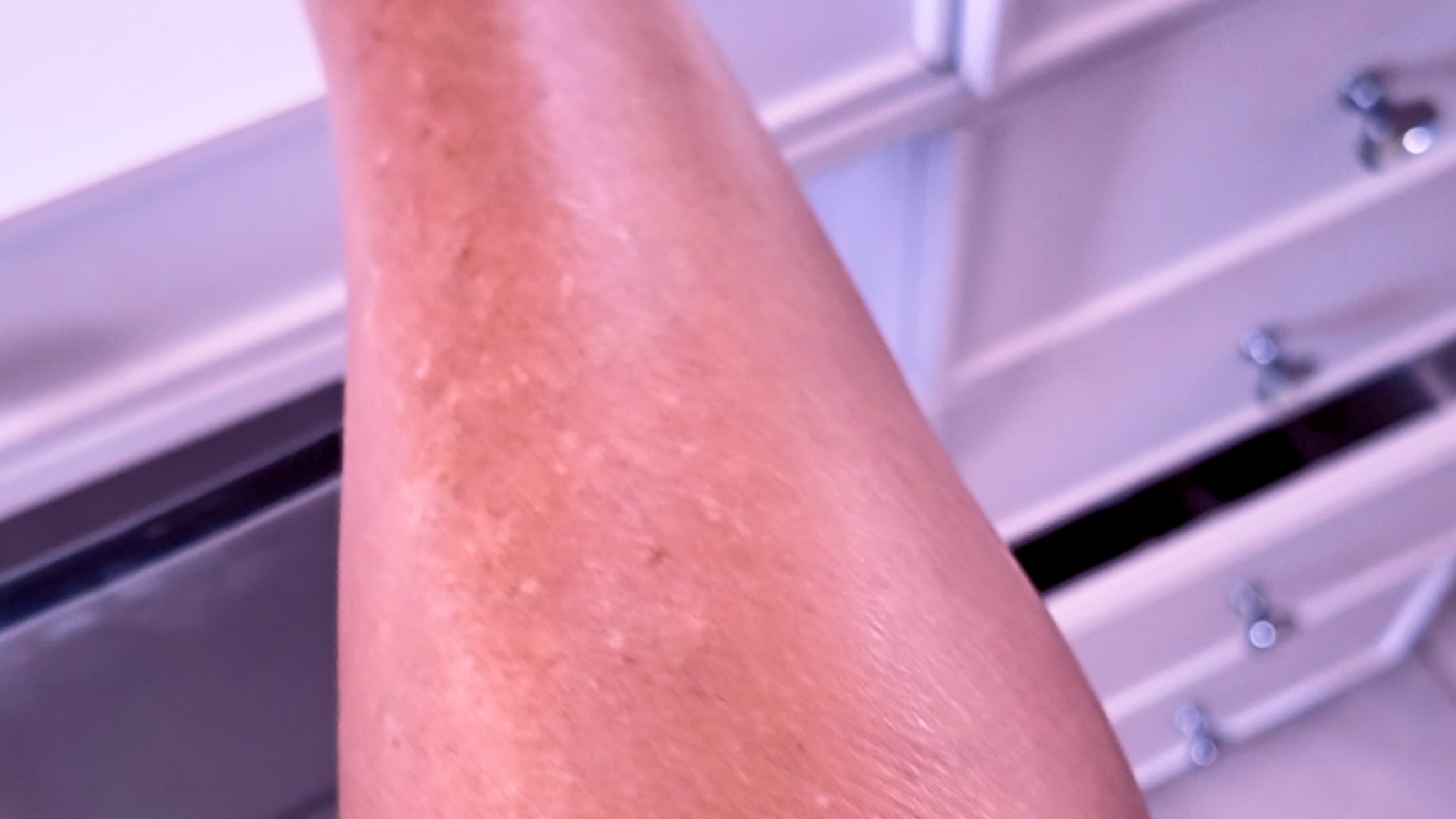 Melanotan 1 vs. 2: My Summer Journey & Real Results - treatment image