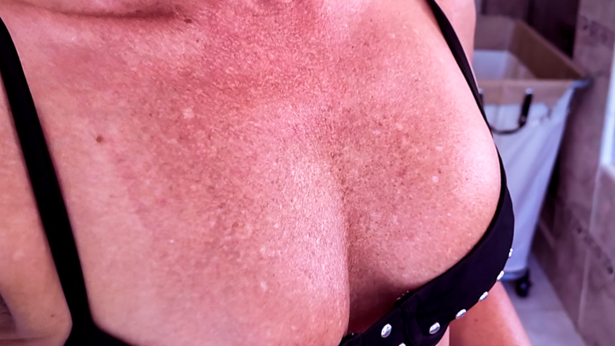 Melanotan 1 vs. 2: My Summer Journey & Real Results - treatment image