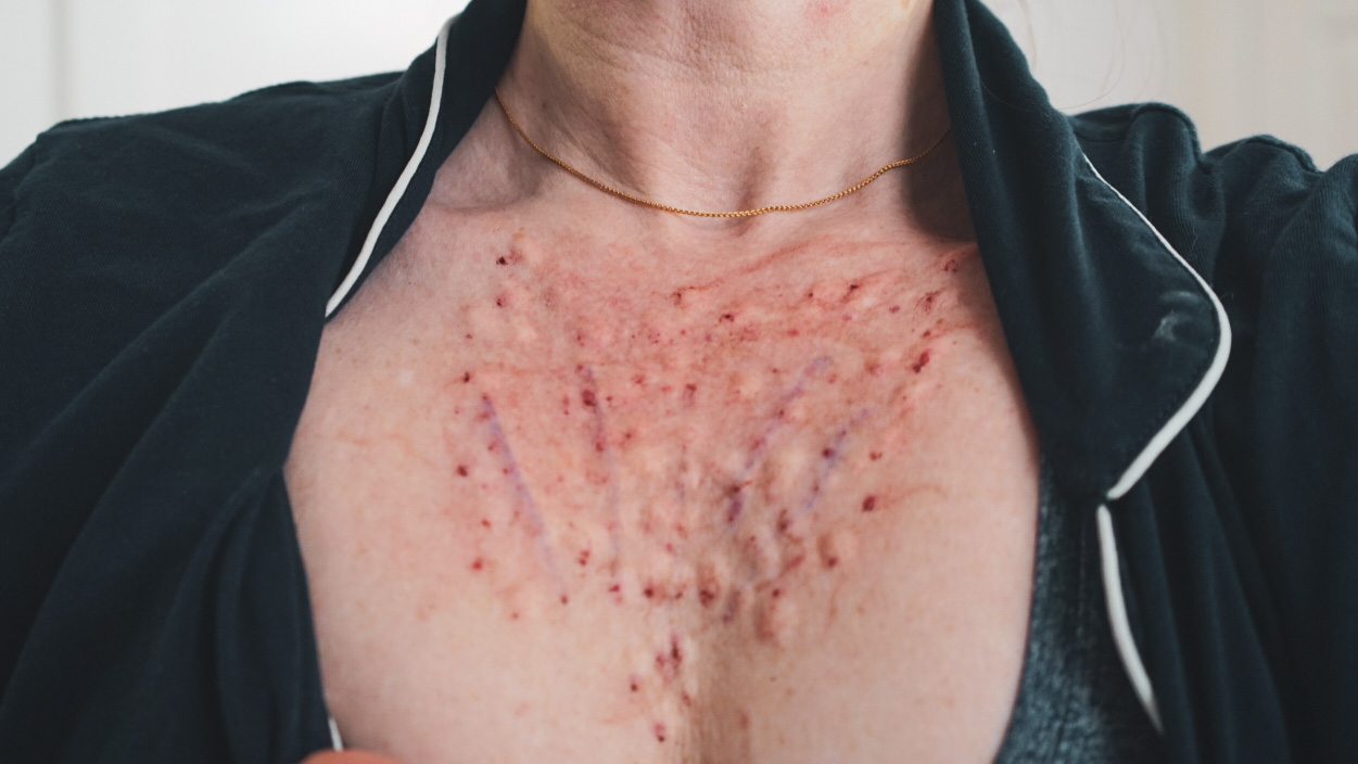 Regenovue Aqua Shine Plus Mesotherapy and PCL Threads - treatment image