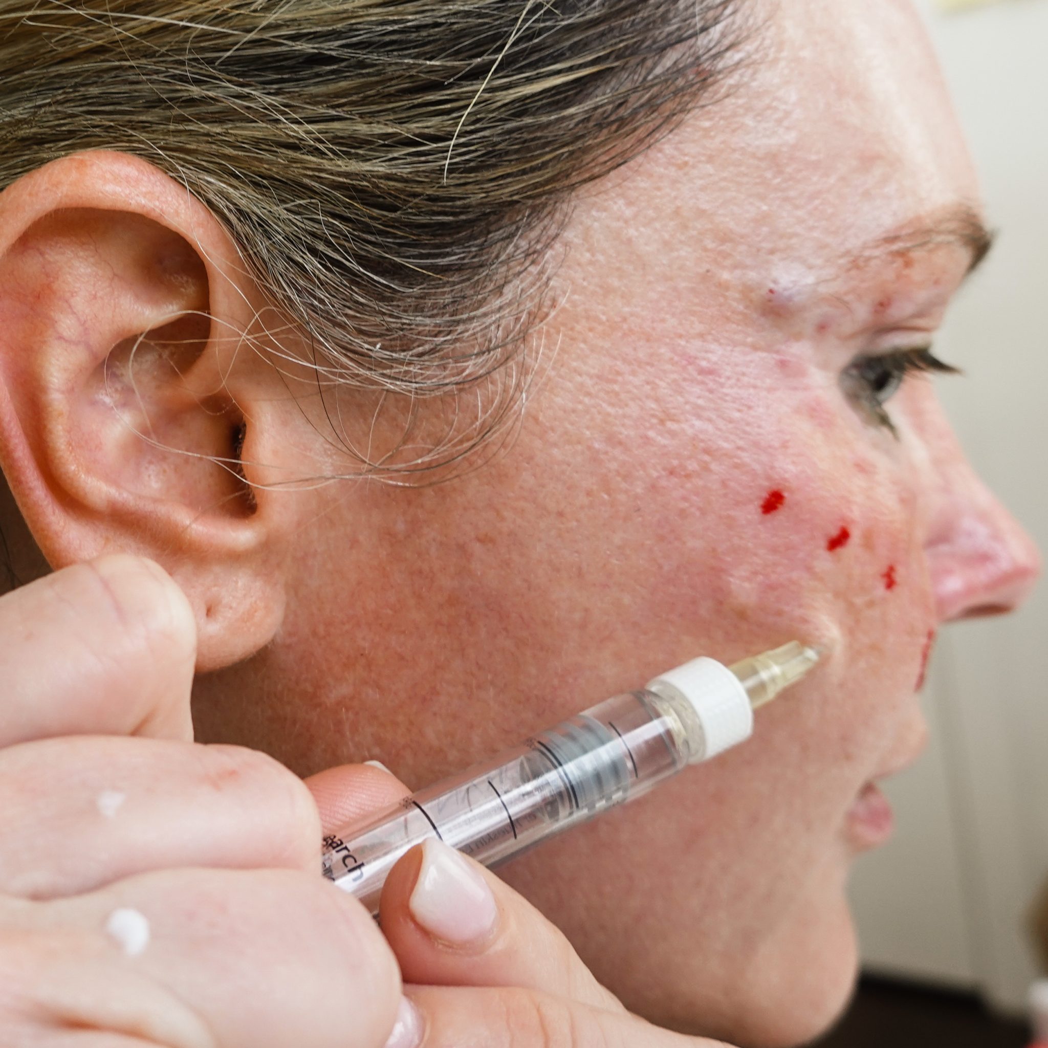 REJURAN HEALER | DERMAHEAL EYE BAG SOLUTION - treatment image