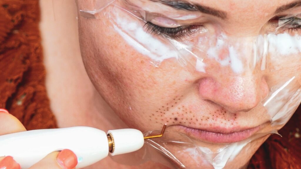 Plasma Fibroblast Experience at Home