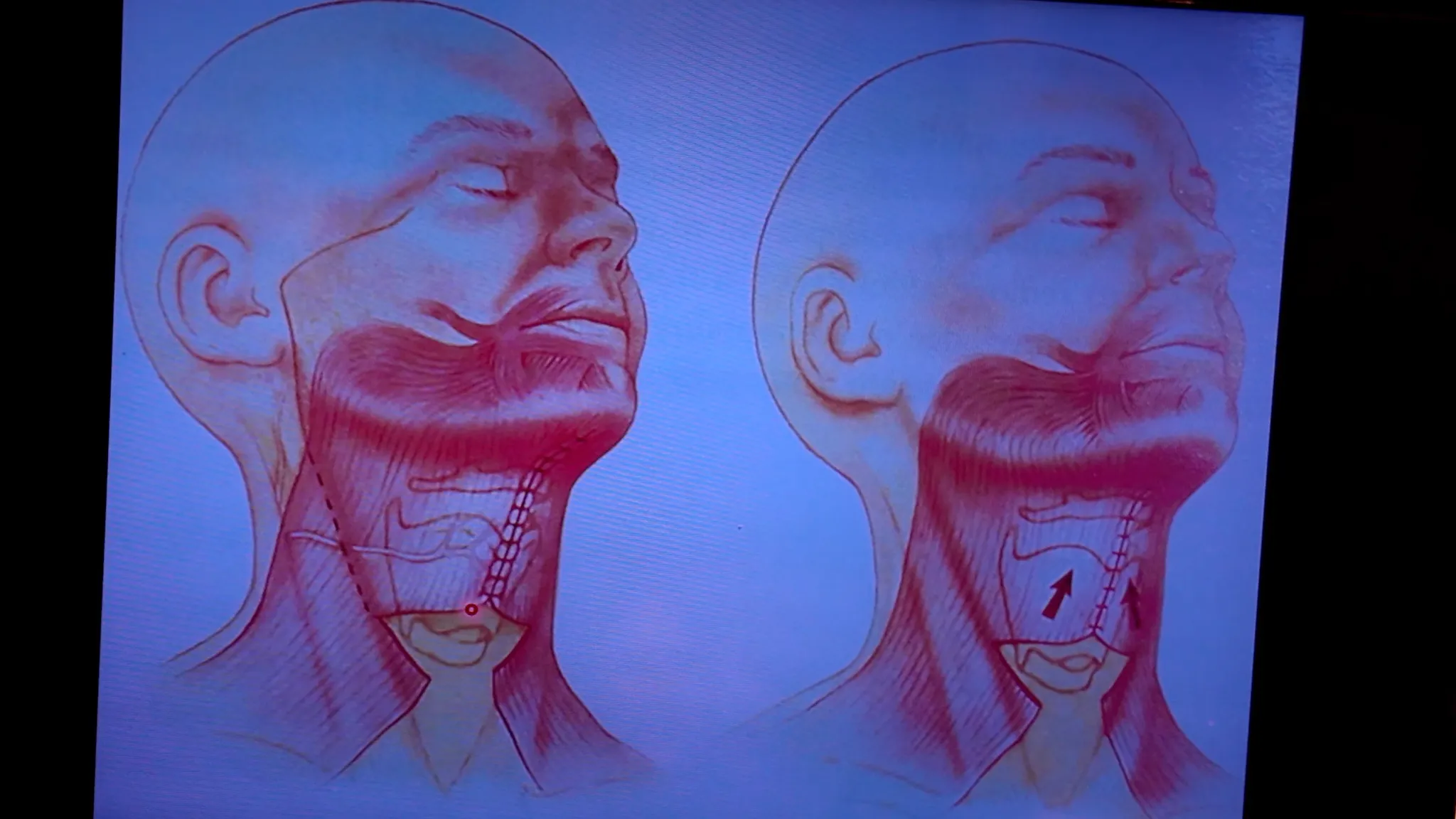 Do I Need a Facelift? Join Me for My Consultation Experience & Cost! - treatment image