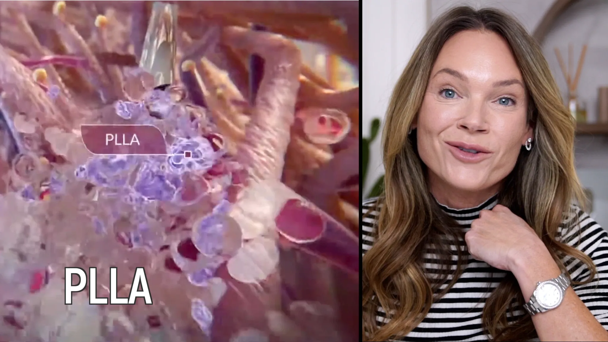 Biostimulators: How to Build Face Volume with Mayster PLLA & Gouri - treatment image