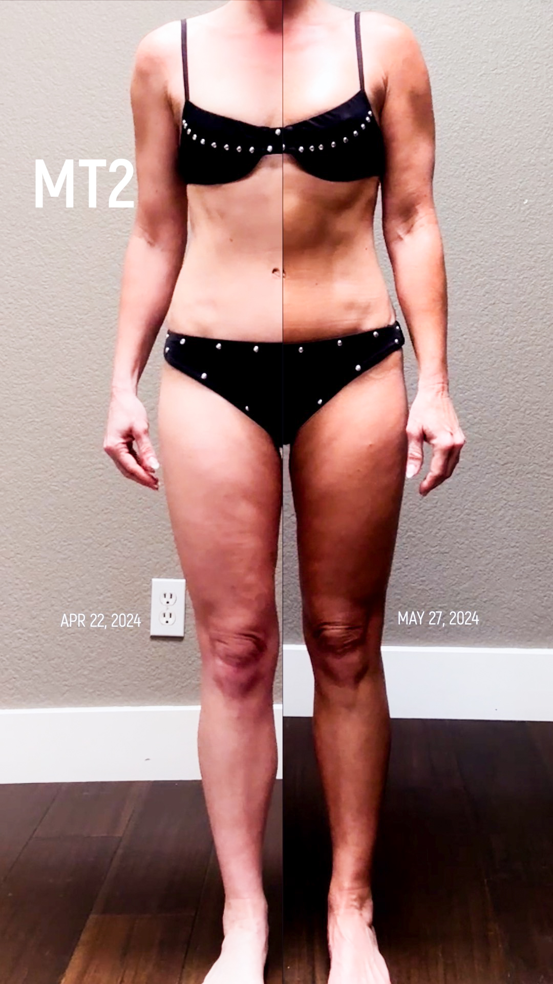 Using Melanotan to Prevent Polymorphous Light Eruption aka SUN POISONING - treatment image