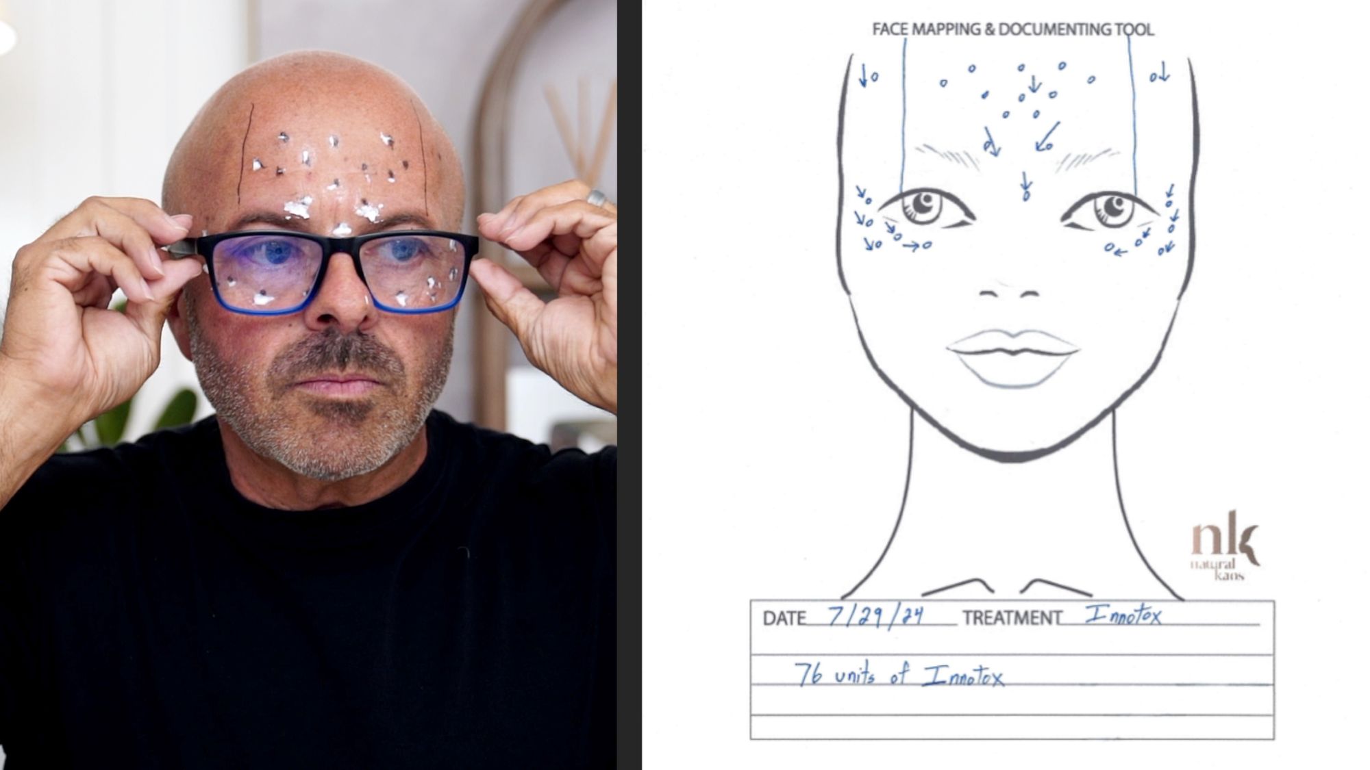 Brotox Breakdown: What You Need to Know About Botox for Guys - treatment image