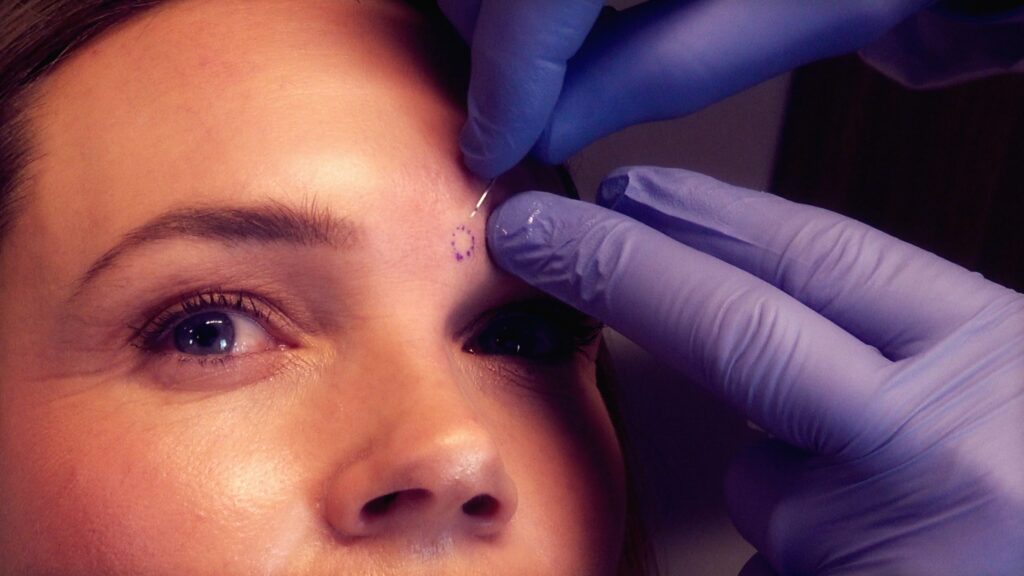 Scar Subcision to Release Chicken Pox Tissue
