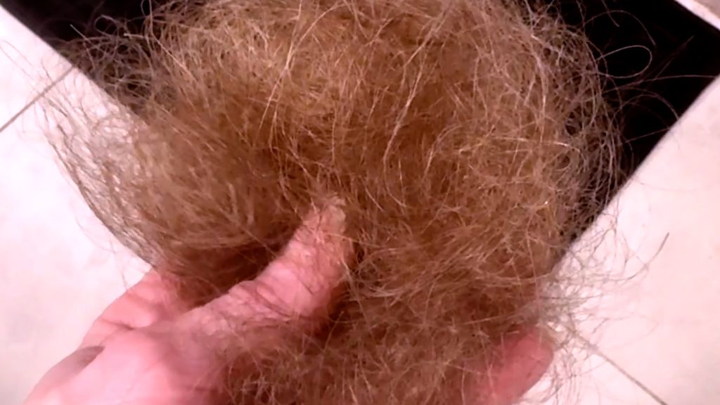 2nd Microneedling with HAIRNA Exosome Hair Fill for Thicker, Fuller Hair! - treatment image