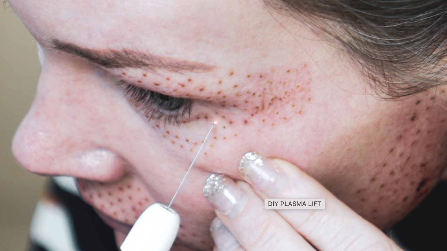 DIY PLASMA LIFT FIBROBLAST DEMO