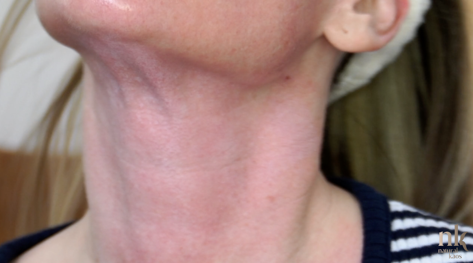 30% TCA and 5% Salicylic Acid Peel Neck & Chest