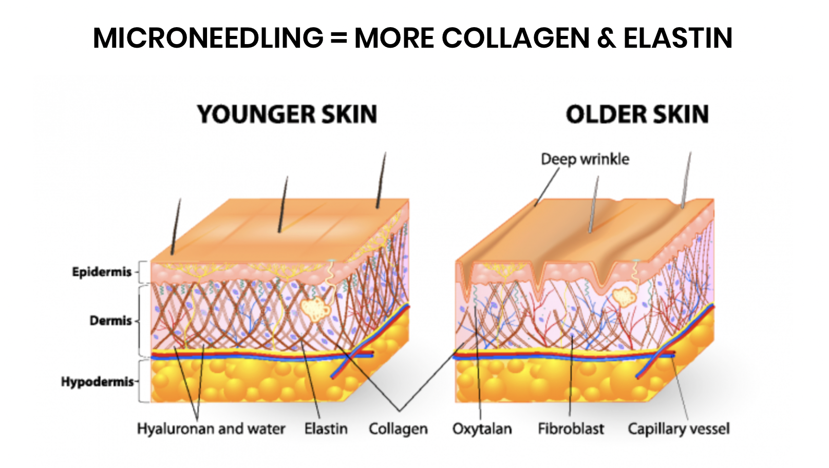 MICRONEEDLING 101 - treatment image
