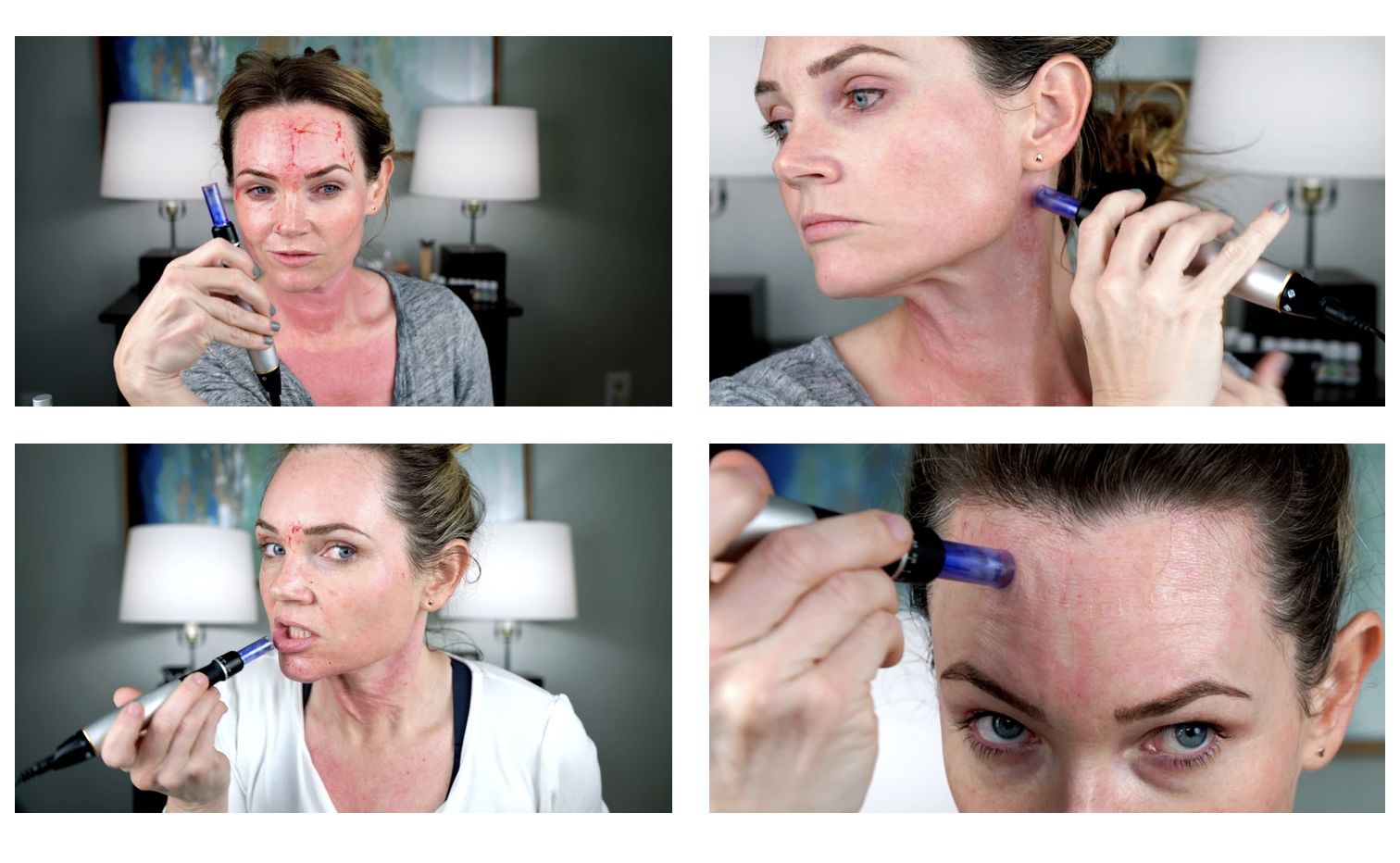 MICRONEEDLING 101 - treatment image
