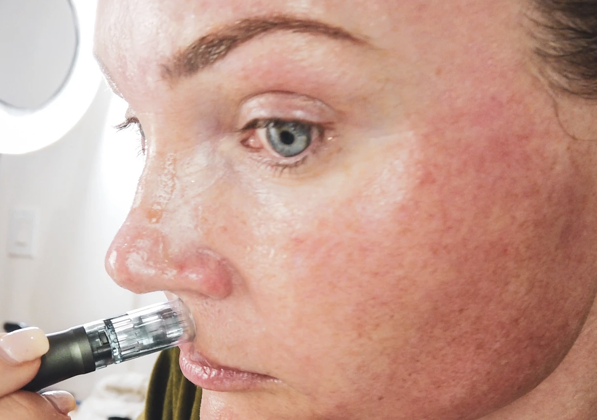 MICRONEEDLING 101 - treatment image