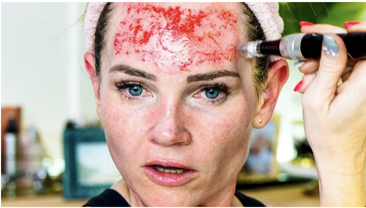 MICRONEEDLING 101 - treatment image
