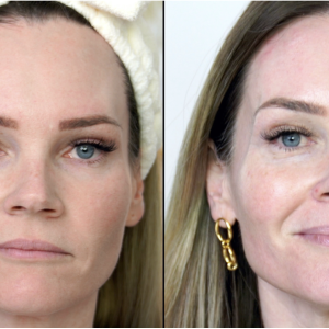 Best Skincare Treatments For Winter - treatment image
