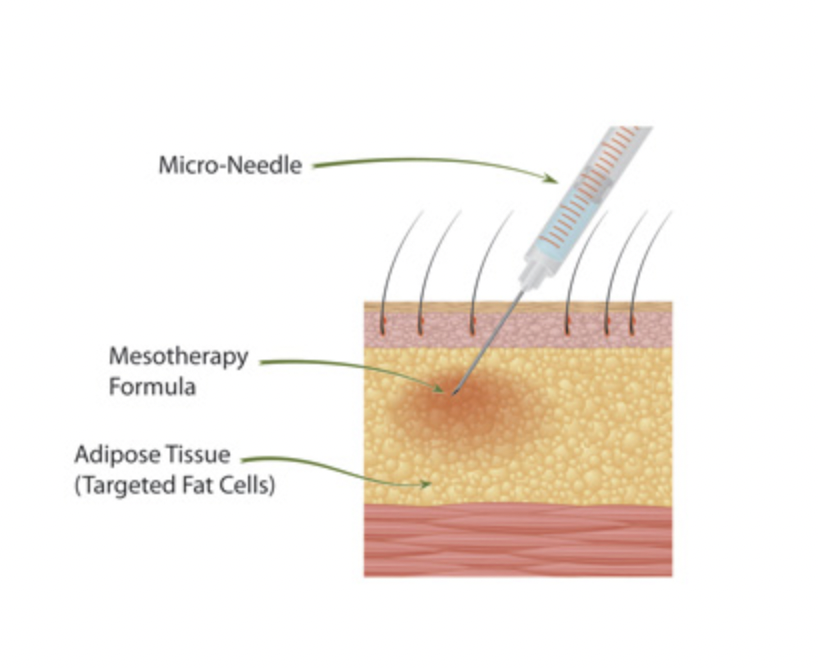MESOTHERAPY - treatment image