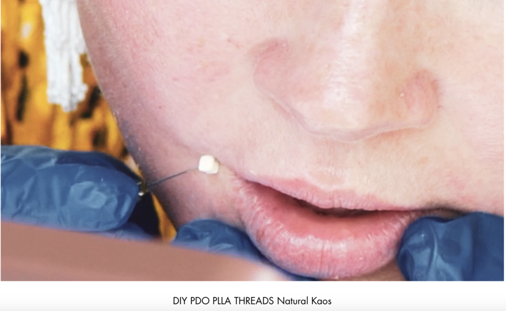 PDO, PLLA and PCL FACIAL THREADS