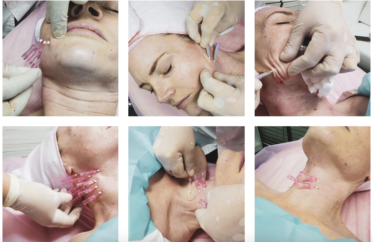 PDO, PLLA and PCL FACIAL THREADS - treatment image