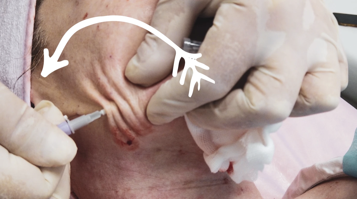 PDO, PLLA and PCL FACIAL THREADS - treatment image