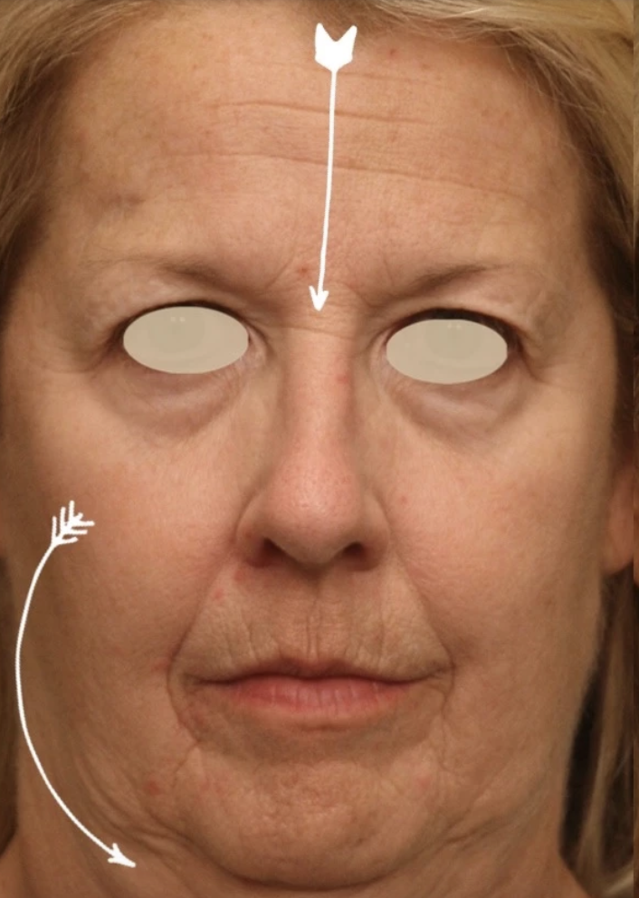PDO, PLLA and PCL FACIAL THREADS - treatment image