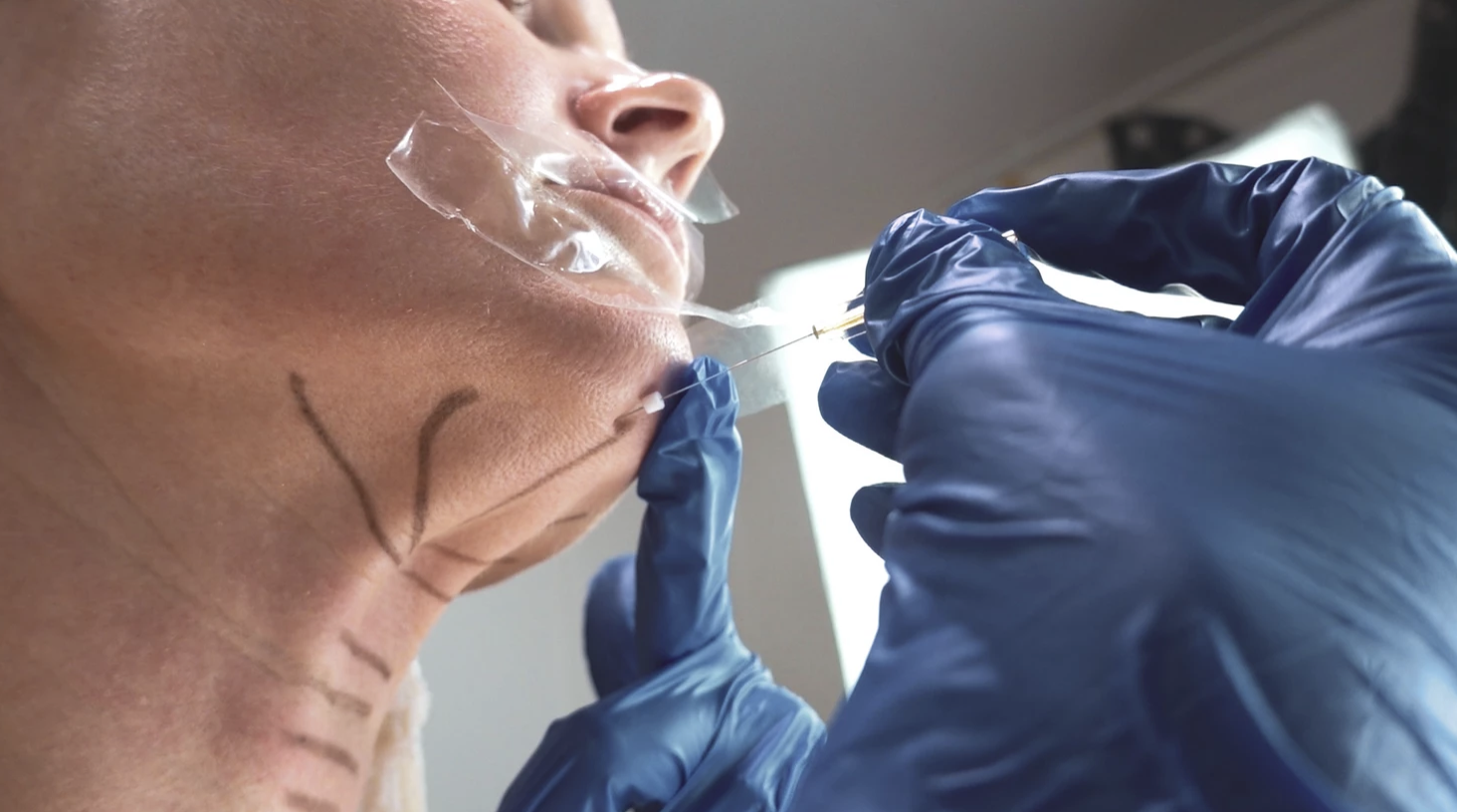 PDO, PLLA and PCL FACIAL THREADS - treatment image