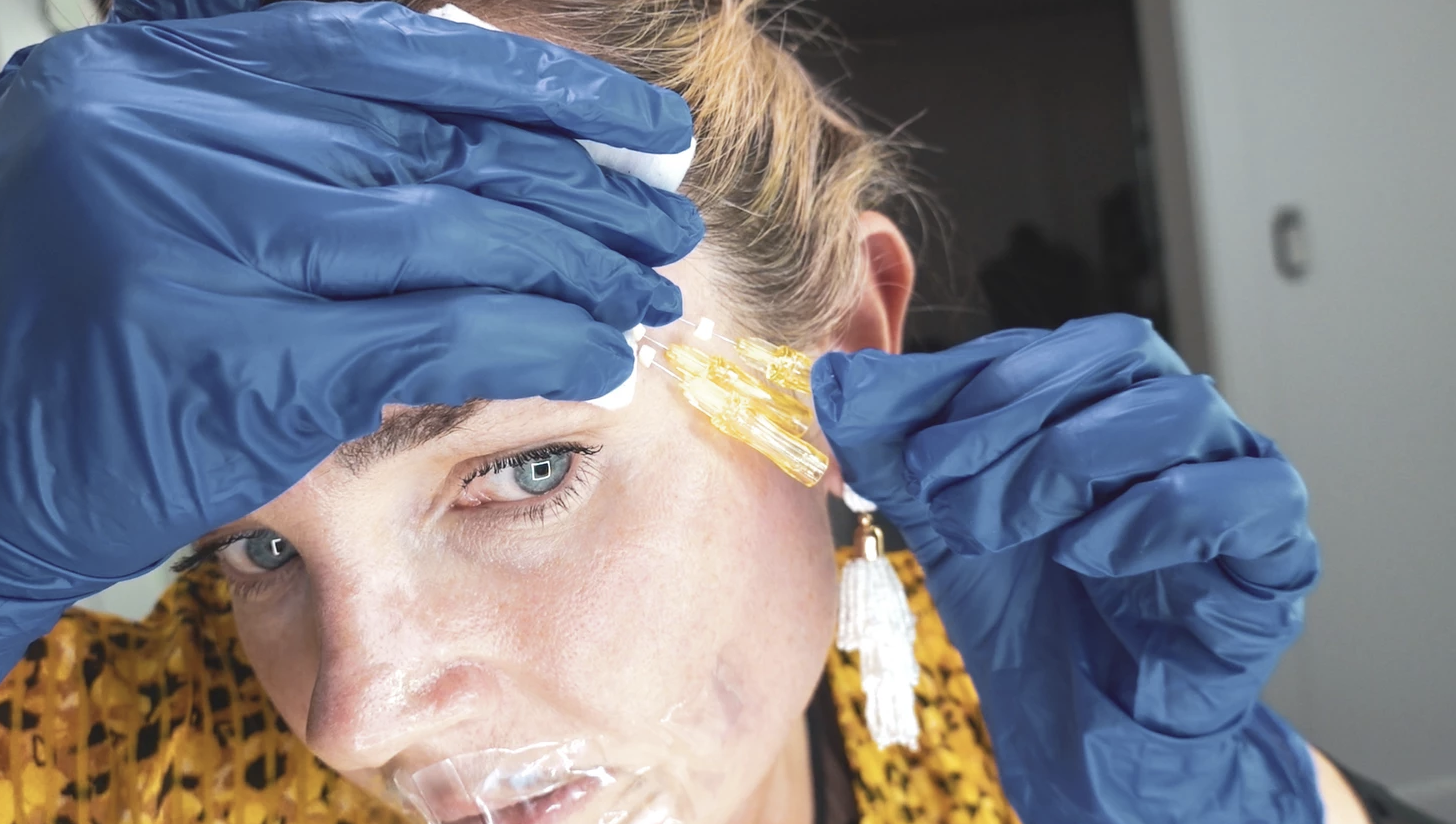 PDO, PLLA and PCL FACIAL THREADS - treatment image