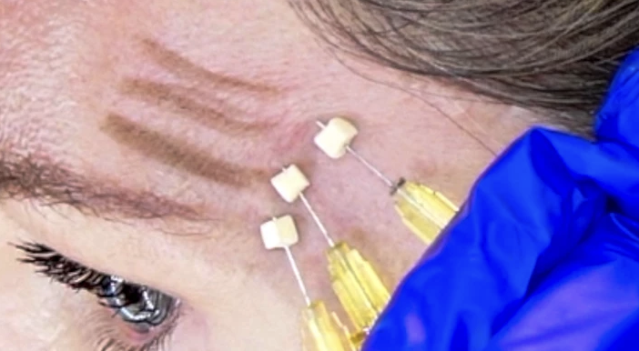 PDO, PLLA and PCL FACIAL THREADS - treatment image