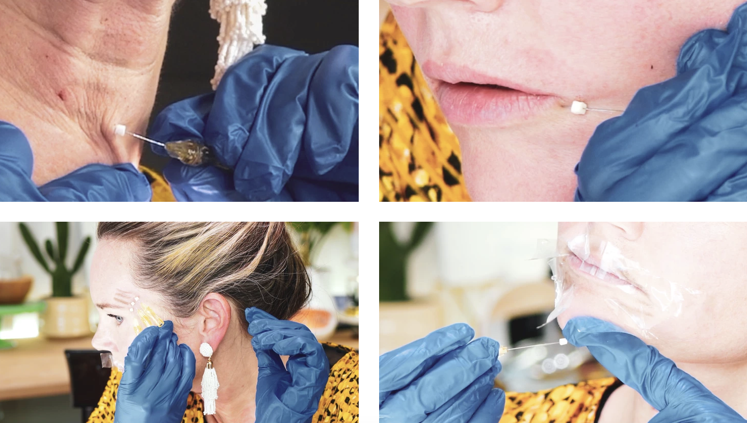 PDO, PLLA and PCL FACIAL THREADS - treatment image