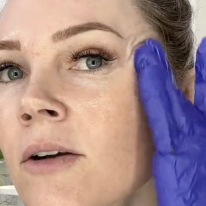 BIENPEEL 35 % TCA The No “Peel” Peel - treatment image
